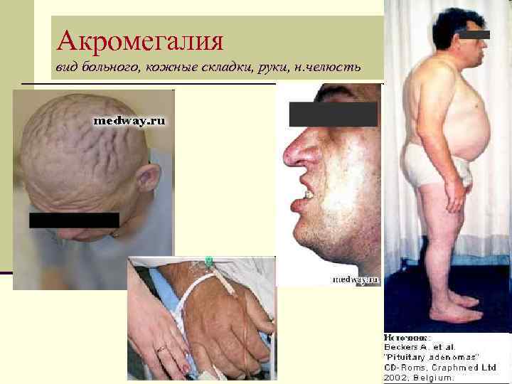 Акромегалия вид больного, кожные складки, руки, н. челюсть 