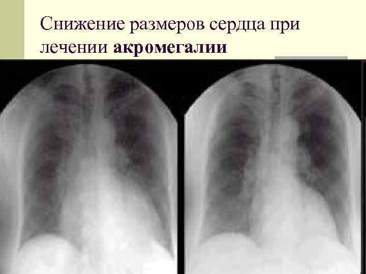 Снижение размеров сердца при лечении акромегалии 