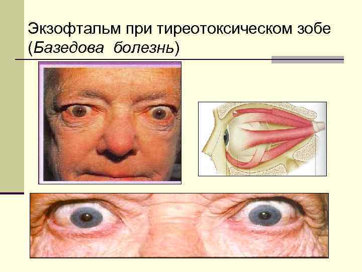 Экзофтальм при тиреотоксическом зобе (Базедова болезнь) 