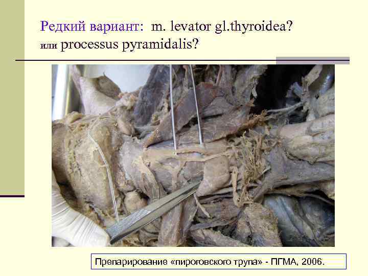 Редкий вариант: m. levator gl. thyroidea? или processus pyramidalis? Препарирование «пироговского трупа» - ПГМА,
