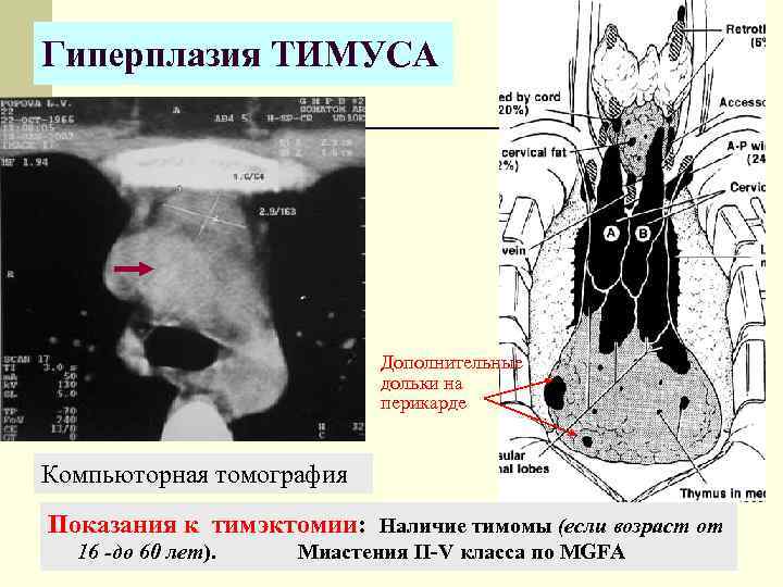 Гиперплазия ТИМУСА Дополнительные дольки на перикарде Компьюторная томография Показания к тимэктомии: Наличие тимомы (если