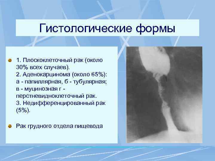 Гистологические формы 1. Плоскоклеточный рак (около 30% всех случаев). 2. Аденокарцинома (около 65%): а