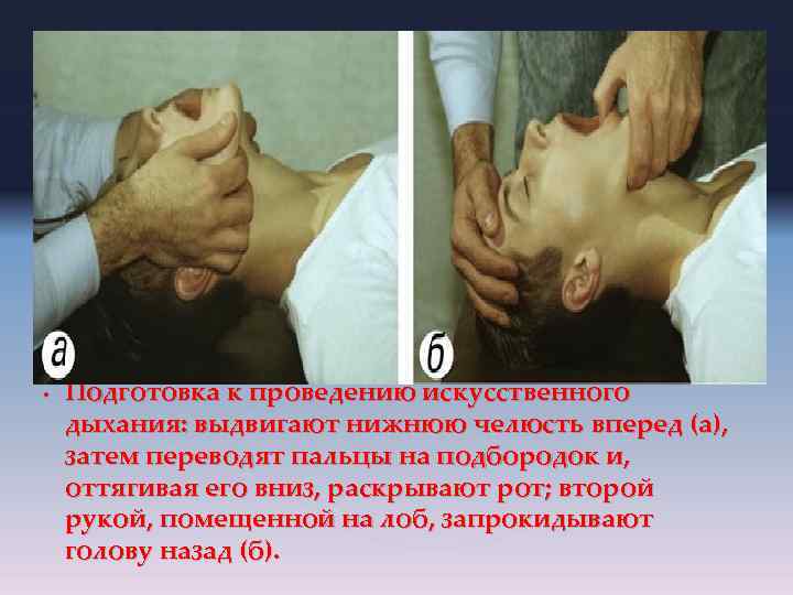  • Подготовка к проведению искусственного дыхания: выдвигают нижнюю челюсть вперед (а), затем переводят