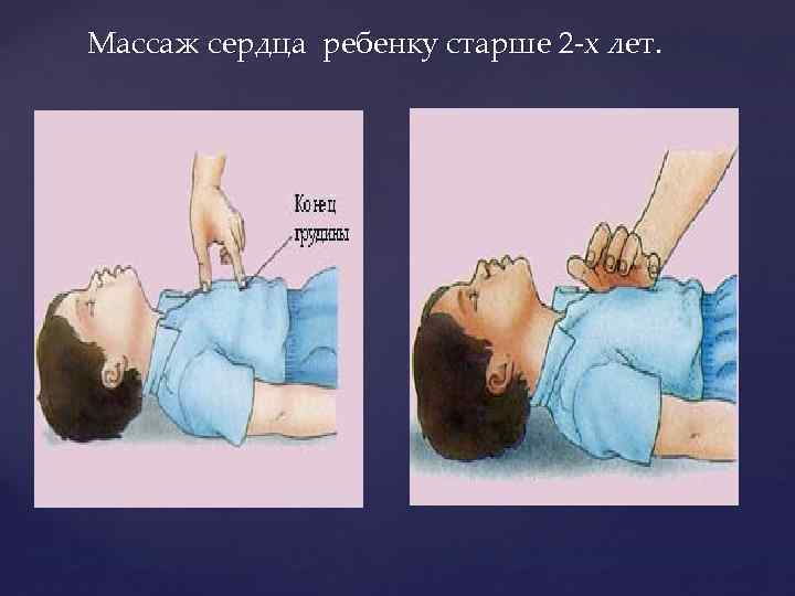 Массаж сердца ребенку старше 2 -х лет. 