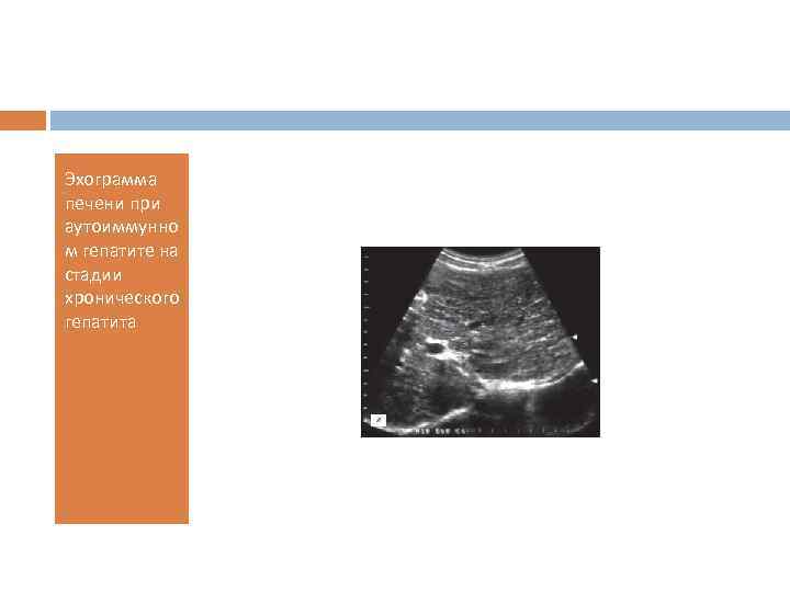 Эхограмма печени при аутоиммунно м гепатите на стадии хронического гепатита 