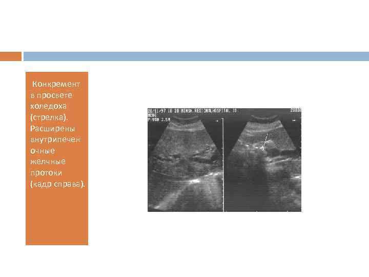  Конкремент в просвете холедоха (стрелка). Расширены внутрипечен очные желчные протоки (кадр справа). 