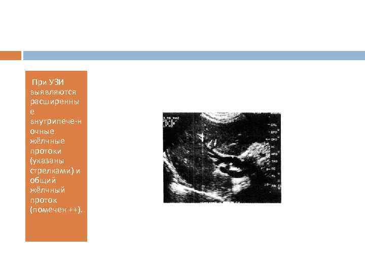  При УЗИ выявляются расширенны е внутрипече н очные жёлчные протоки (указаны стрелками) и