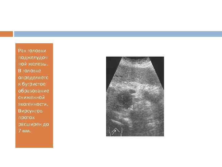Рак головки поджелудоч ной железы. В головке определяетс я бугристое образование сниженной эхогенности. Вирсунгов