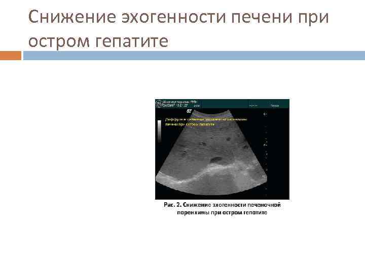 Снижение эхогенности печени при остром гепатите 