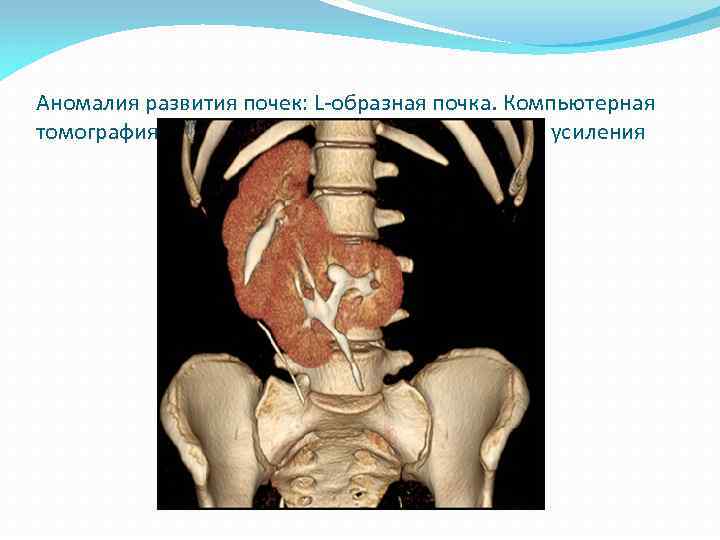 Аномалия развития почек: L-образная почка. Компьютерная томография на фоне внутривенного контрастного усиления 