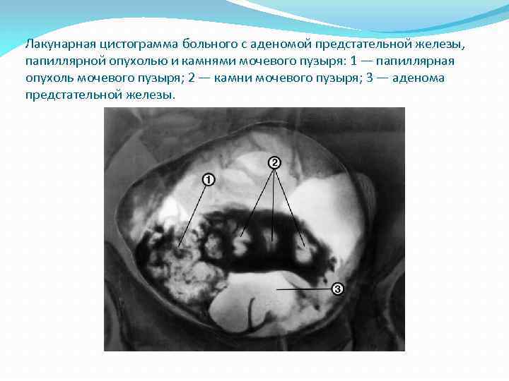 Лакунарная цистограмма больного с аденомой предстательной железы, папиллярной опухолью и камнями мочевого пузыря: 1