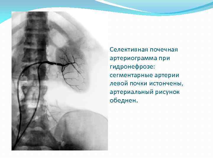 Селективная почечная артериограмма при гидронефрозе: сегментарные артерии левой почки истончены, артериальный рисунок обеднен. 