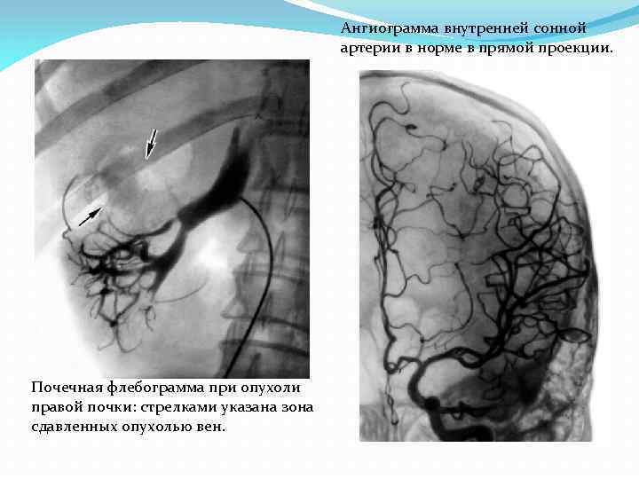 Ангиограмма внутренней сонной артерии в норме в прямой проекции. Почечная флебограмма при опухоли правой