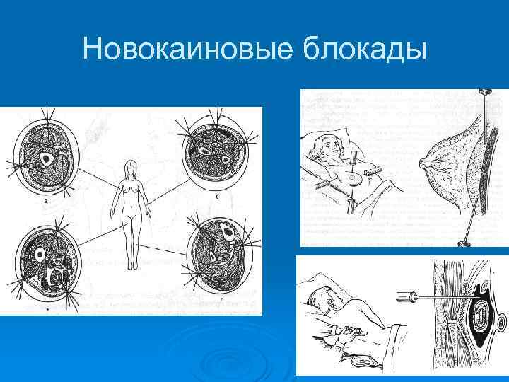 Новокаиновые блокады 