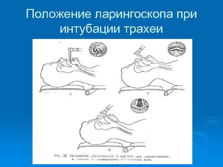 Положение ларингоскопа при интубации трахеи 