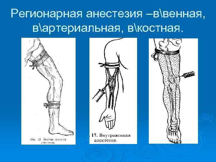 Регионарная анестезия презентация