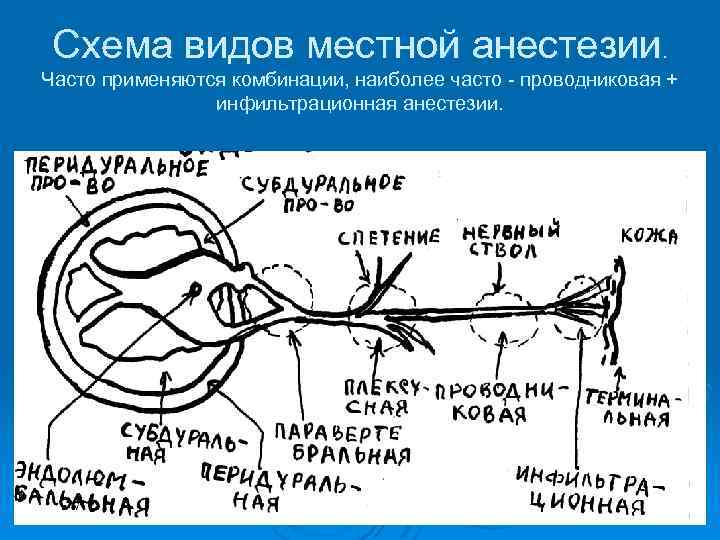 Схема видов местной анестезии. Часто применяются комбинации, наиболее часто - проводниковая + инфильтрационная анестезии.