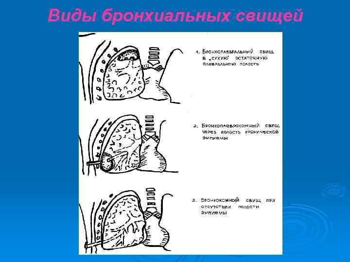 Виды бронхиальных свищей 