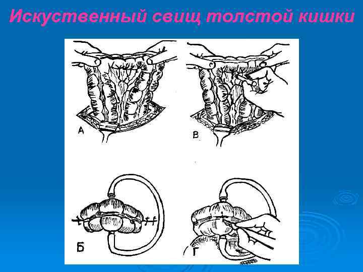 Искуственный свищ толстой кишки 