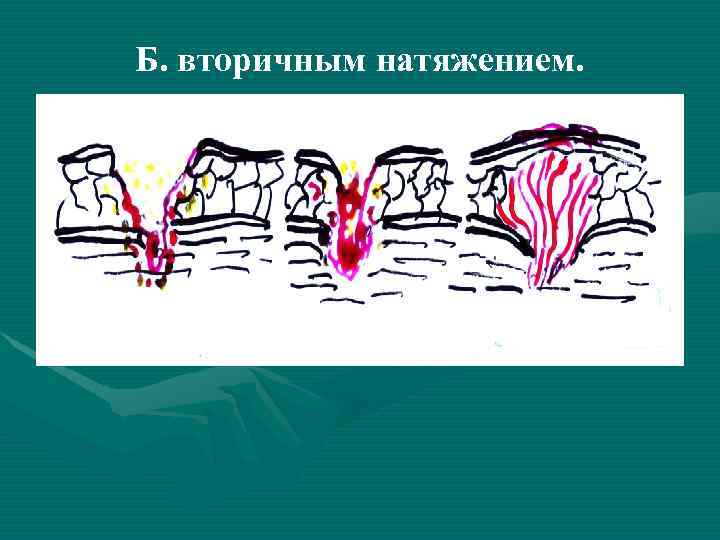 Вторичная рана. Шов вторичного натяжения. Рана вторичное натяжение раны. Вторичное натяжение раны обработка.