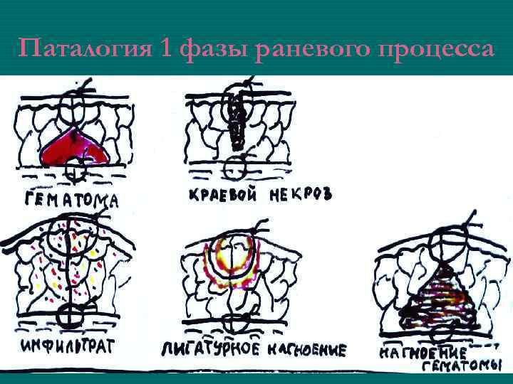 Паталогия 1 фазы раневого процесса 