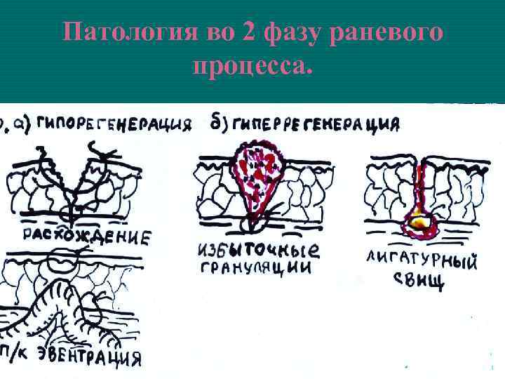 Патология во 2 фазу раневого процесса. 