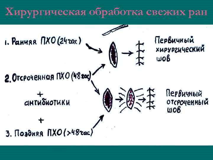 Хирургическая обработка свежих ран 