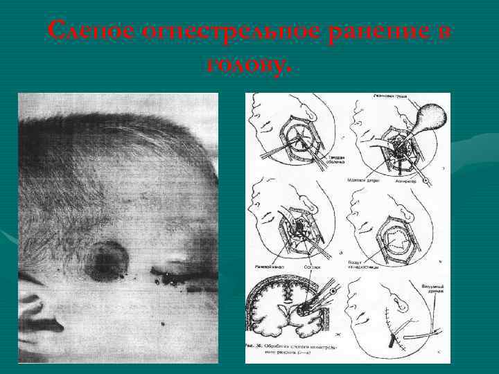 Слепое огнестрельное ранение в голову. 