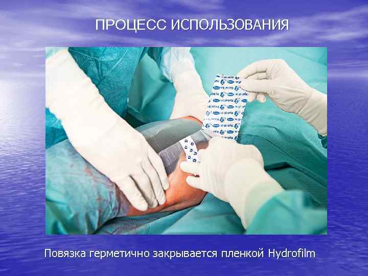 ПРОЦЕСС ИСПОЛЬЗОВАНИЯ Повязка герметично закрывается пленкой Hydrofilm 