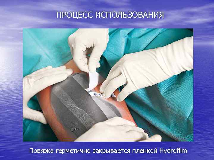 ПРОЦЕСС ИСПОЛЬЗОВАНИЯ Повязка герметично закрывается пленкой Hydrofilm 