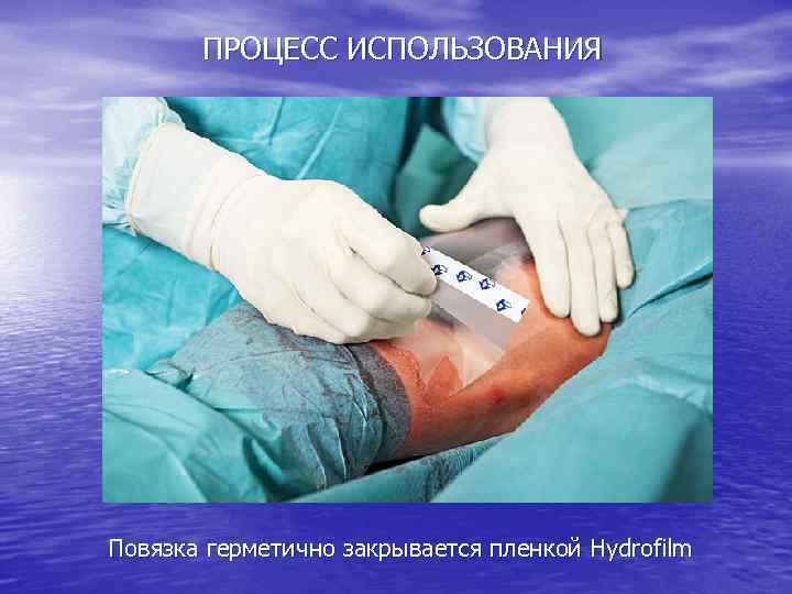 ПРОЦЕСС ИСПОЛЬЗОВАНИЯ Повязка герметично закрывается пленкой Hydrofilm 