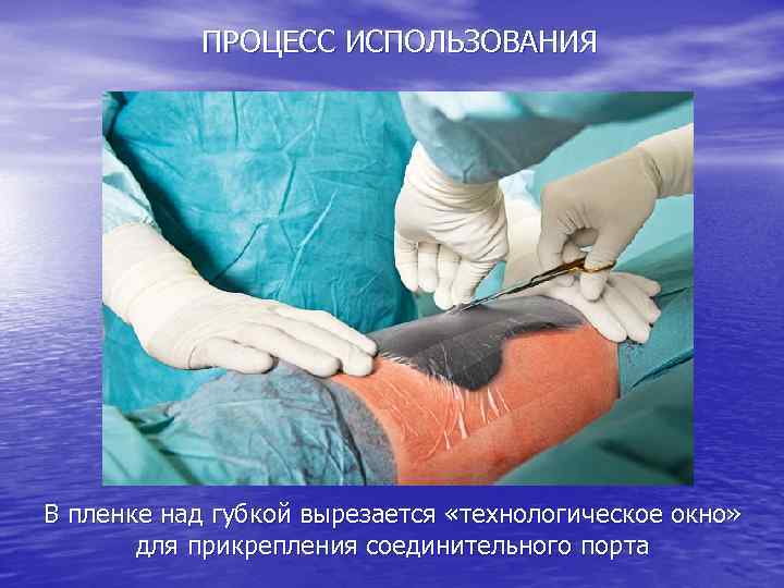 ПРОЦЕСС ИСПОЛЬЗОВАНИЯ В пленке над губкой вырезается «технологическое окно» для прикрепления соединительного порта 