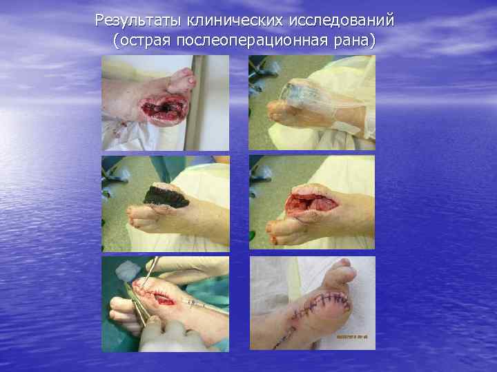 Результаты клинических исследований (острая послеоперационная рана) 