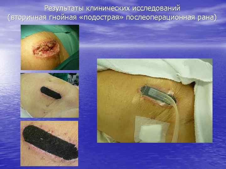 Результаты клинических исследований (вторичная гнойная «подострая» послеоперационная рана) 
