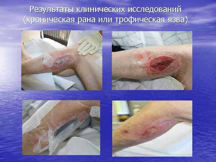 Результаты клинических исследований (хроническая рана или трофическая язва) 
