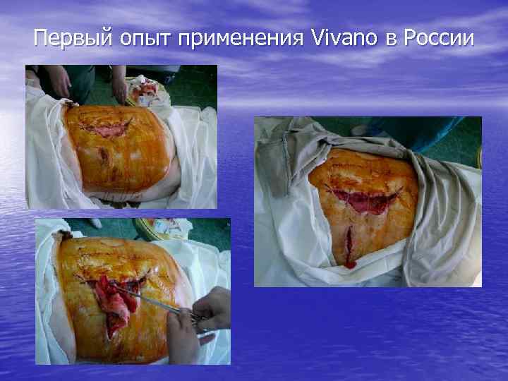 Первый опыт применения Vivano в России 