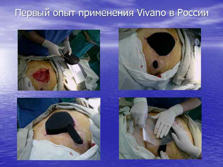 Первый опыт применения Vivano в России 