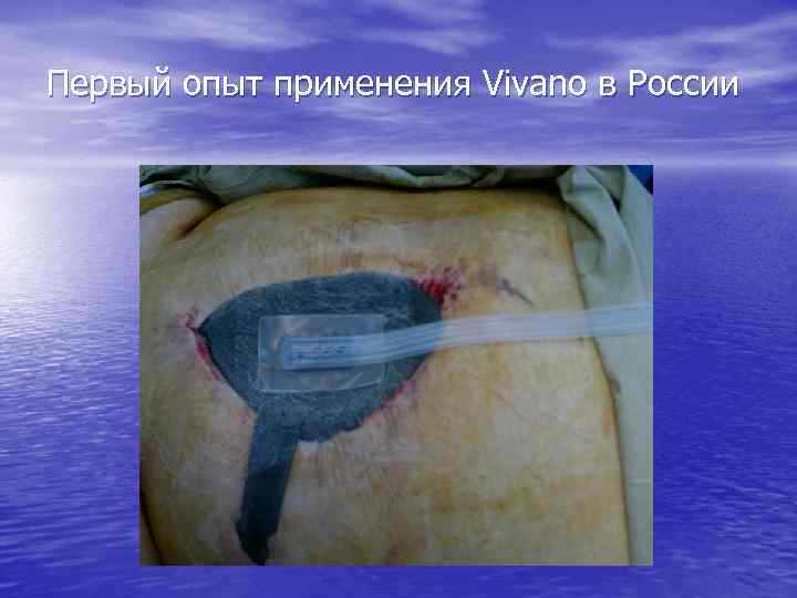 Первый опыт применения Vivano в России 