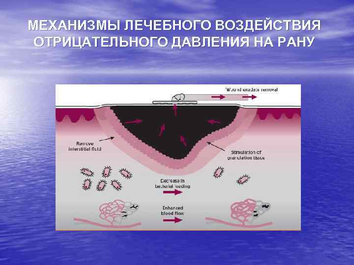 МЕХАНИЗМЫ ЛЕЧЕБНОГО ВОЗДЕЙСТВИЯ ОТРИЦАТЕЛЬНОГО ДАВЛЕНИЯ НА РАНУ 