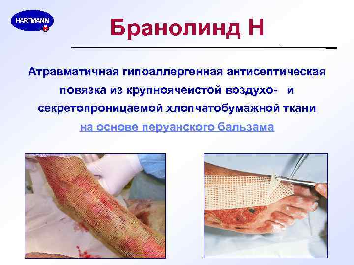 Бранолинд Н Атравматичная гипоаллергенная антисептическая повязка из крупноячеистой воздухо- и секретопроницаемой хлопчатобумажной ткани на