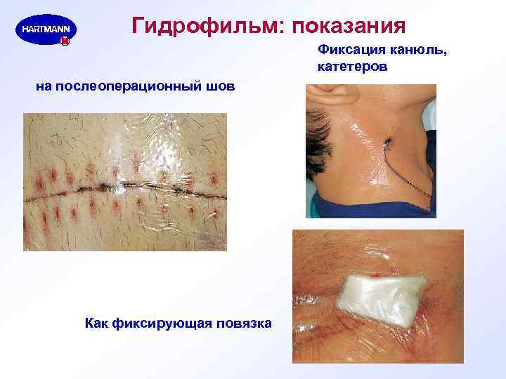Гидрофильм: показания Фиксация канюль, катетеров на послеоперационный шов Как фиксирующая повязка 