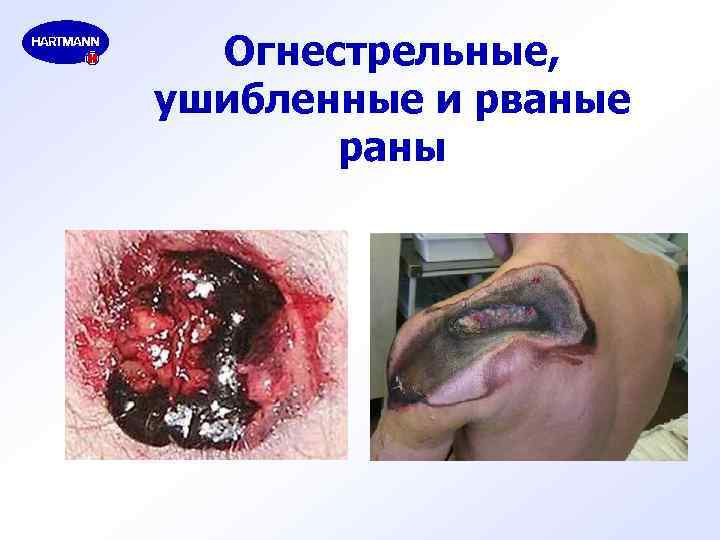 Огнестрельные, ушибленные и рваные раны 