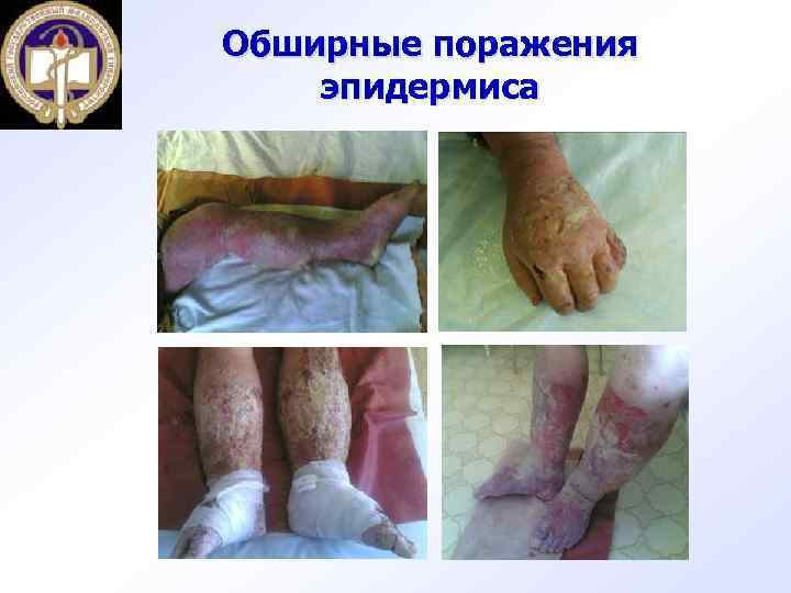 Обширные поражения эпидермиса 