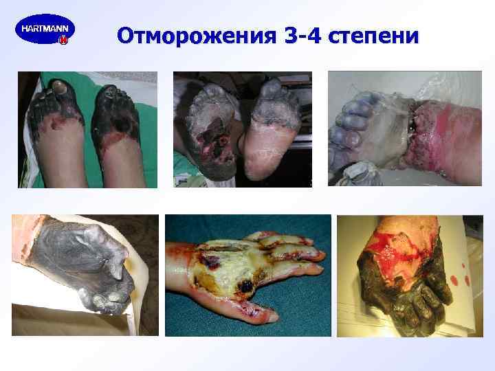 Отморожения 3 -4 степени 