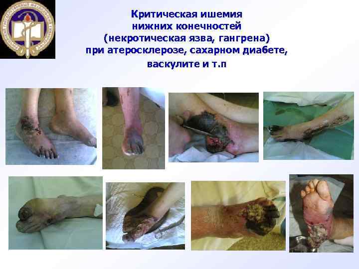 Критическая ишемия нижних конечностей (некротическая язва, гангрена) при атеросклерозе, сахарном диабете, васкулите и т.