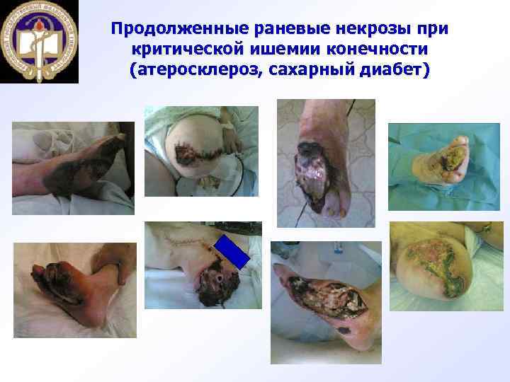 Продолженные раневые некрозы при критической ишемии конечности (атеросклероз, сахарный диабет) 