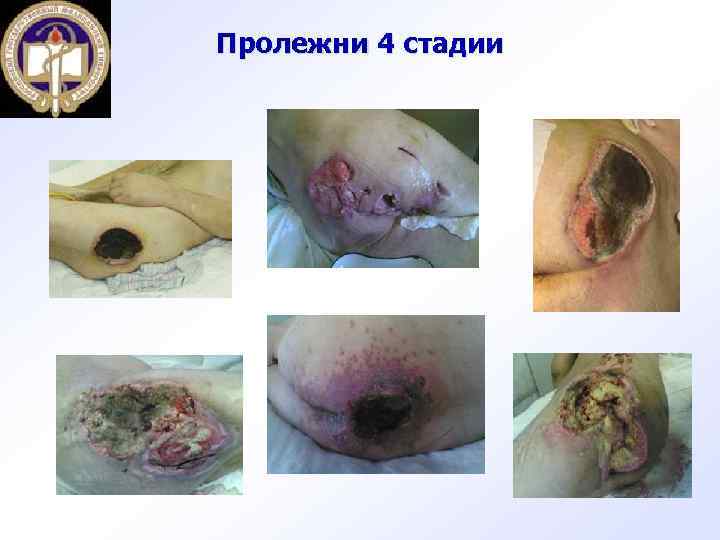 Пролежни 4 стадии 