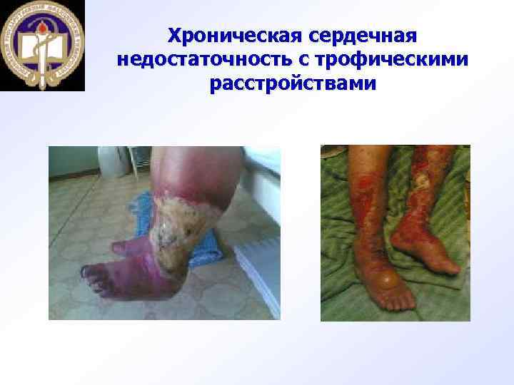 Хроническая сердечная недостаточность с трофическими расстройствами 