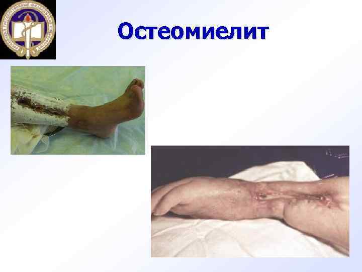 Остеомиелит 