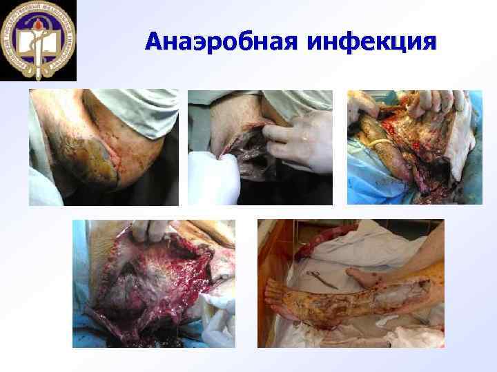 Анаэробная инфекция 